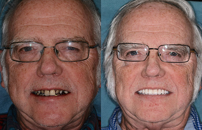 -HZA™ -🦷Advanced Customized Full Denture Set🦷 (⏰Limited time discount last 30 minutes⏰)