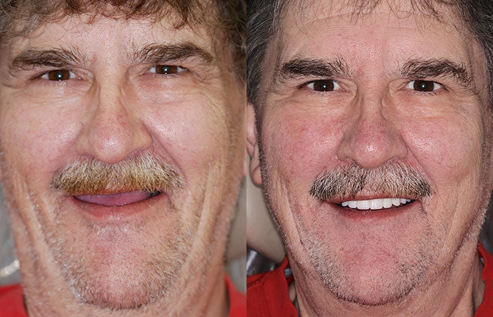 -HZA™ -🦷Advanced Customized Full Denture Set🦷 (⏰Limited time discount last 30 minutes⏰)