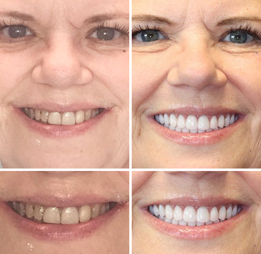-HZA™ -🦷Advanced Customized Full Denture Set🦷 (⏰Limited time discount last 30 minutes⏰)