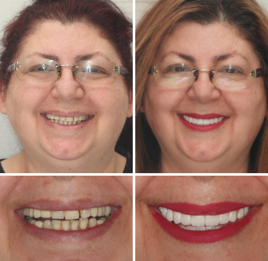 -HZA™ -🦷Advanced Customized Full Denture Set🦷 (⏰Limited time discount last 30 minutes⏰)