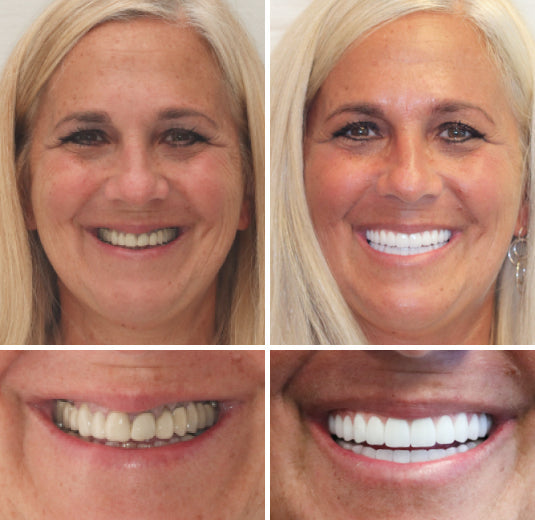-HZA™ -🦷Advanced Customized Full Denture Set🦷 (⏰Limited time discount last 30 minutes⏰)