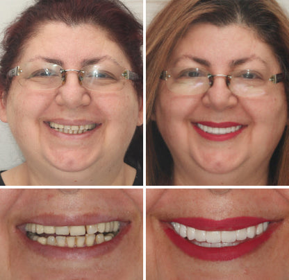 HZA™ ---🦷Advanced Customized Full Denture Set🦷 (⏰Limited time discount last 30 minutes⏰)