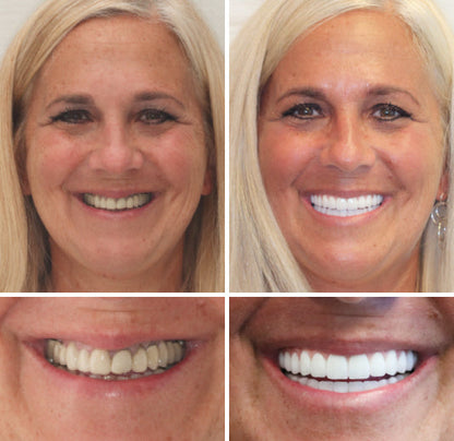 HZA™ ---🦷Advanced Customized Full Denture Set🦷 (⏰Limited time discount last 30 minutes⏰)